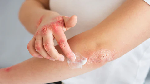Desarrollan tratamiento de triple acción contra la dermatitis atópica en Chile